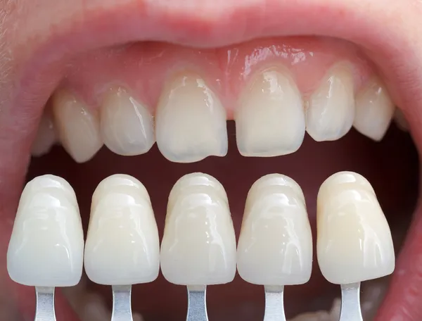 Discover the Top 5 Ways to Care for Your Dental Veneers for Longevity
