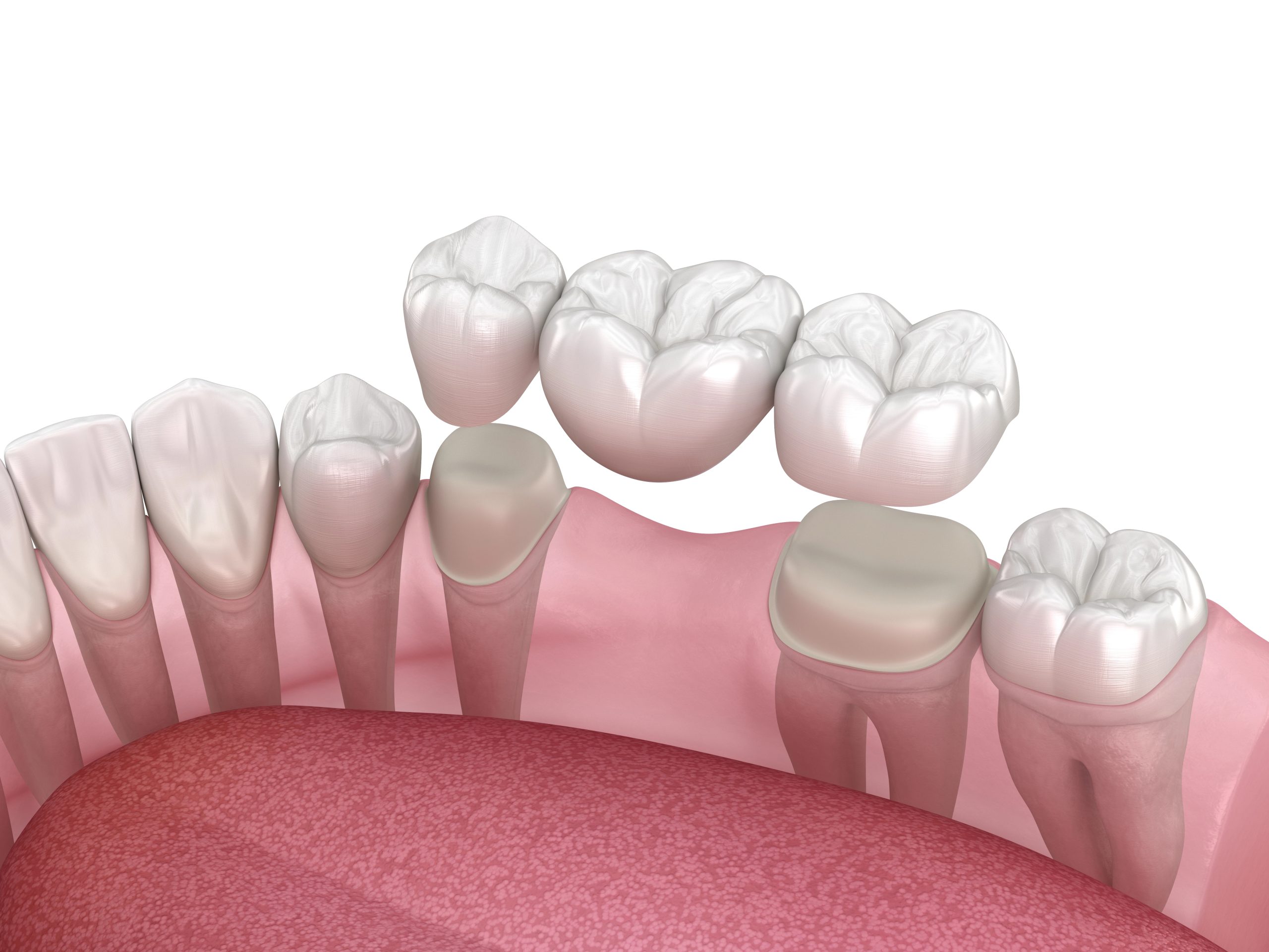 Are Dental Bridges the Right Solution for Your Missing Teeth?